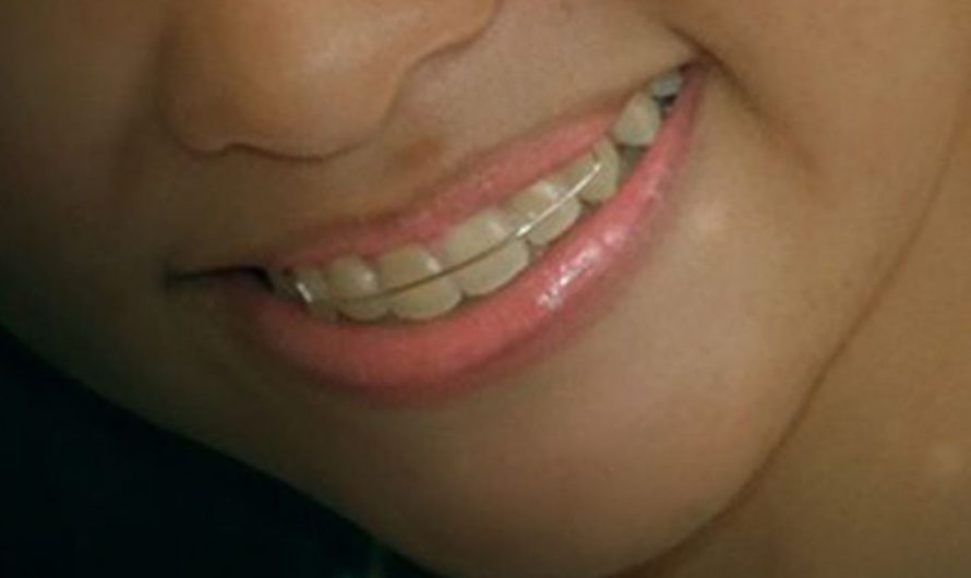 22 symbolic meanings of dreaming about braces