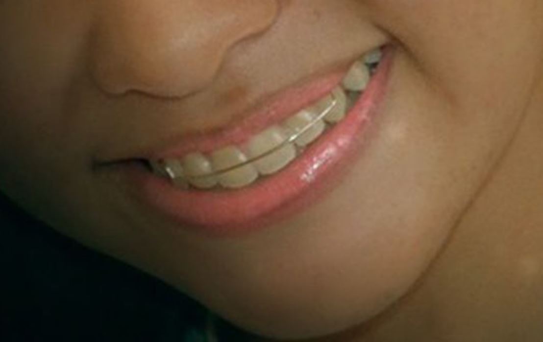 22 symbolic meanings of dreaming about braces